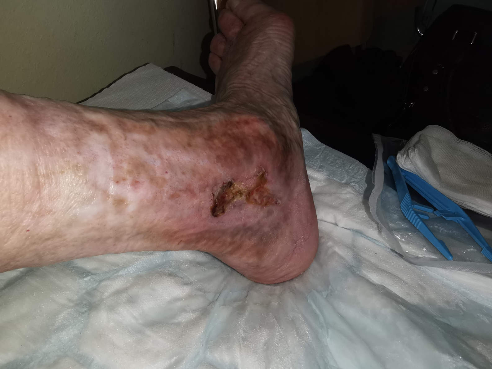 Psihološko so pomembni prvi meseci po znotrajžilnem zdravljenju krčnih žil zaradi rane, saj nam dajo odgovor o končnem rezultatu.